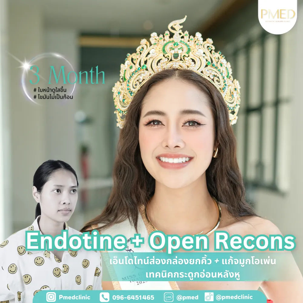 endotine-000012