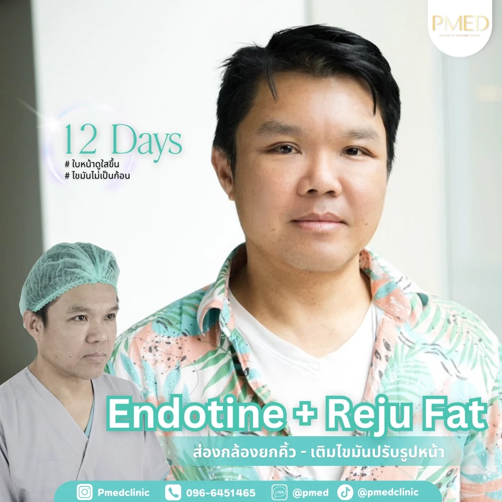 endotine-000013