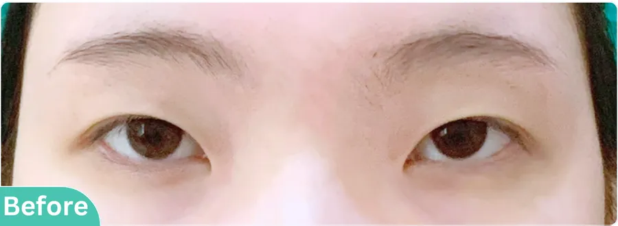 eyelid-surgery-00010