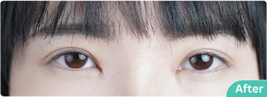 eyelid-surgery-00011