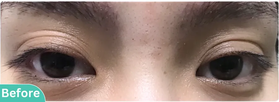 eyelid-surgery-00012