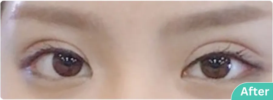 eyelid-surgery-00013