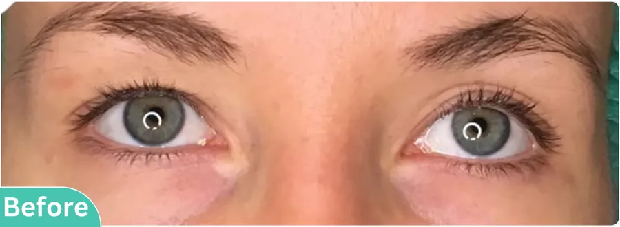 eyelid-surgery-00014ง