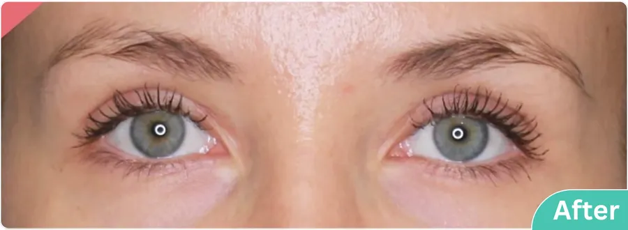 eyelid-surgery-00015