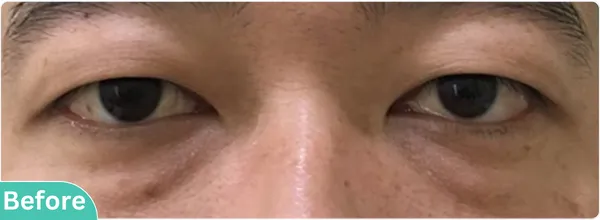eyelid-surgery-00016