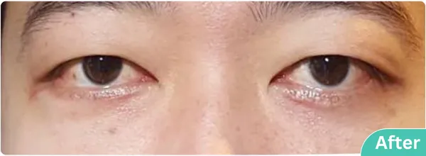 eyelid-surgery-00017