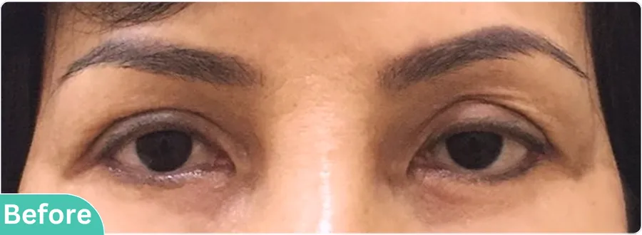 eyelid-surgery-00018