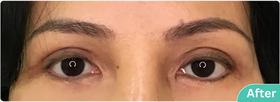 eyelid-surgery-00019