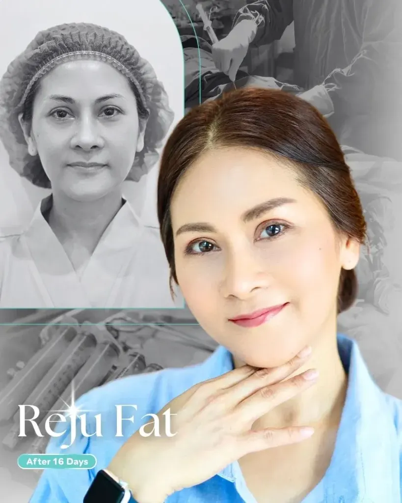 facial-fat-grafting-00001