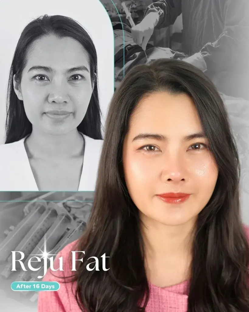 facial-fat-grafting-00003