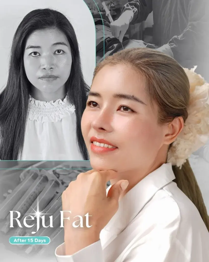 facial-fat-grafting-00004