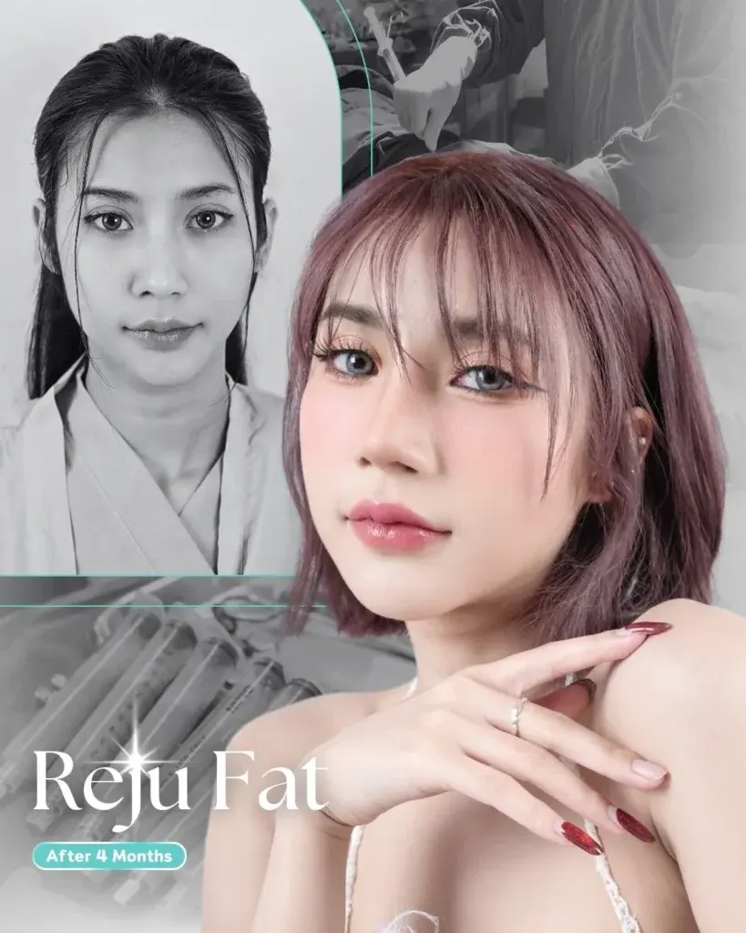 facial-fat-grafting-00005