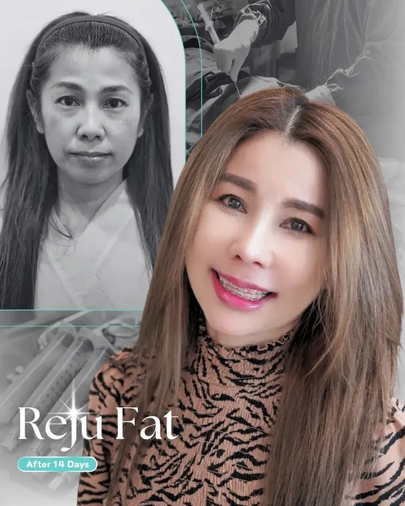 facial-fat-grafting-00007