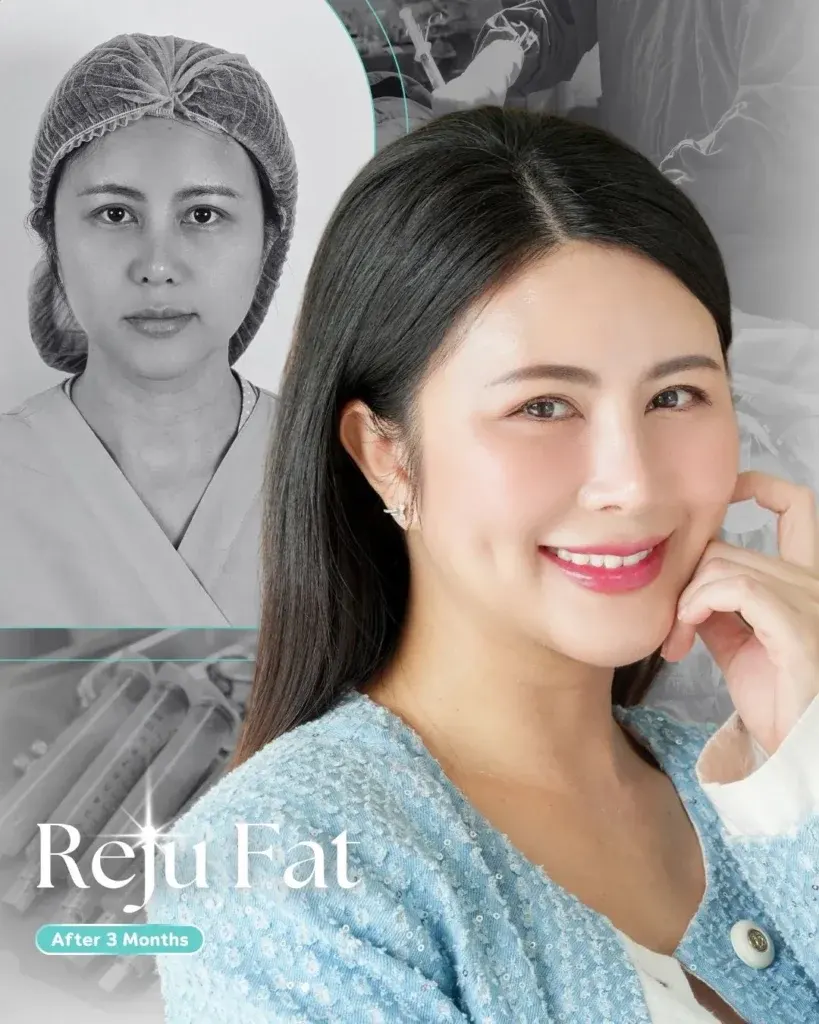facial-fat-grafting-00008