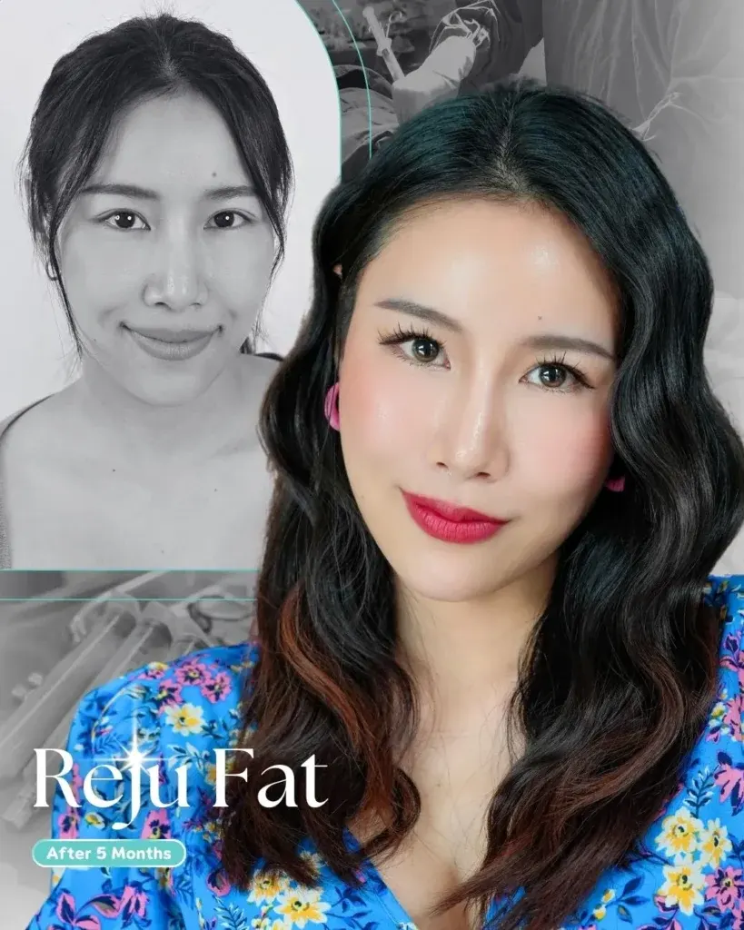 facial-fat-grafting-00009