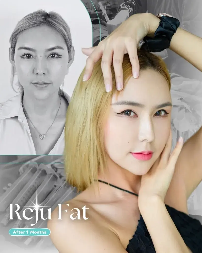 facial-fat-grafting-00011