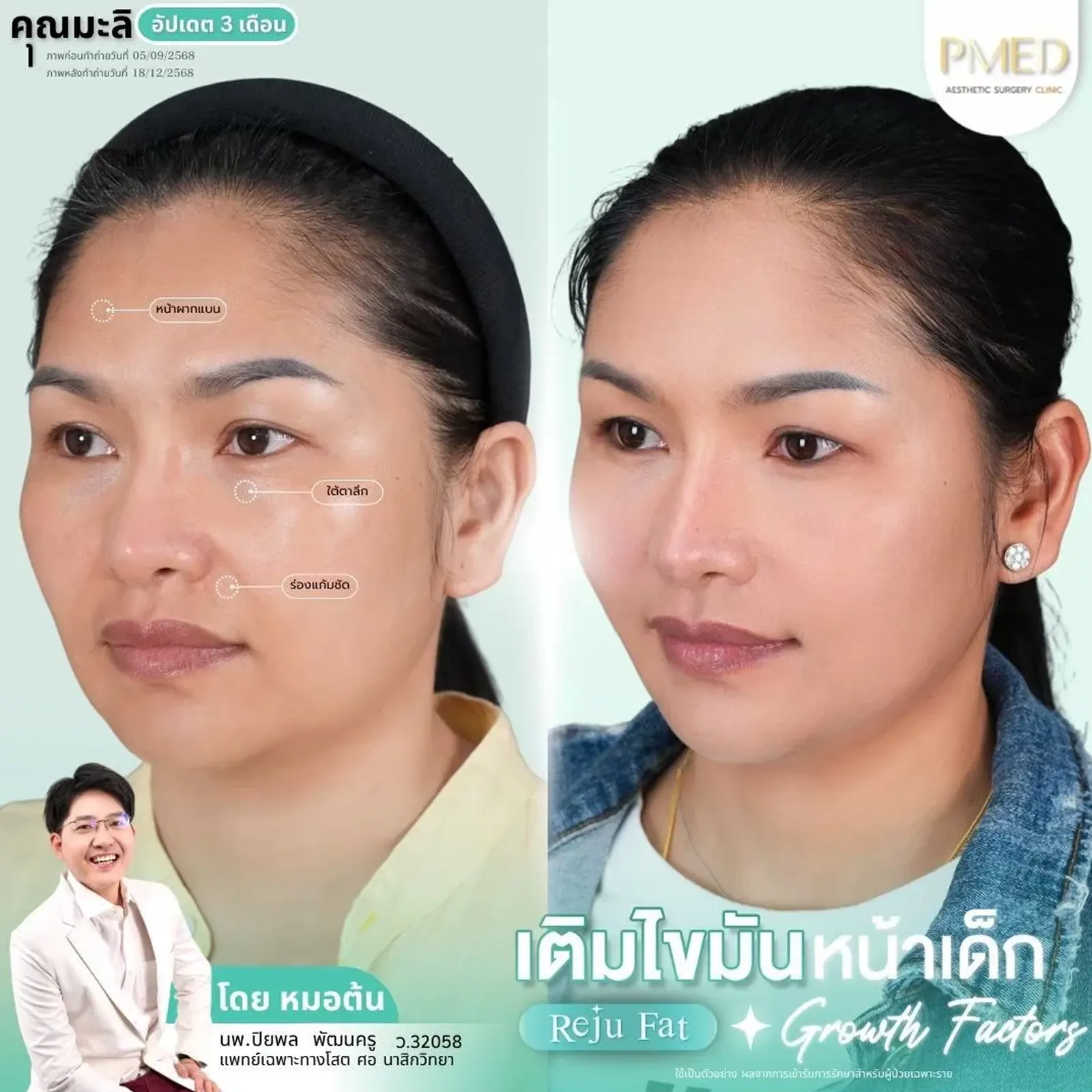 facial-fat-grafting-00013
