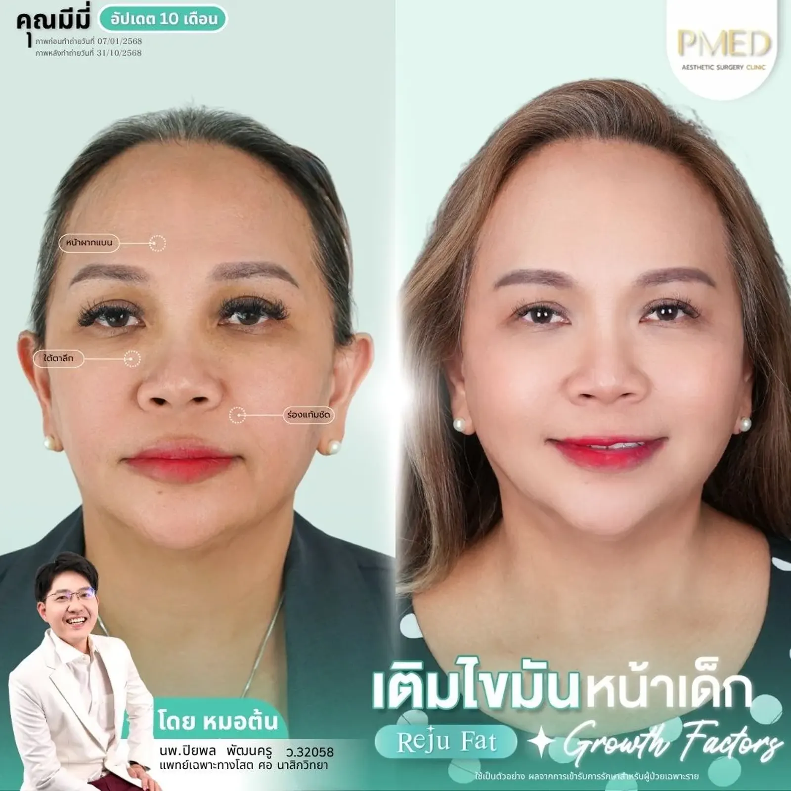 facial-fat-grafting-00014