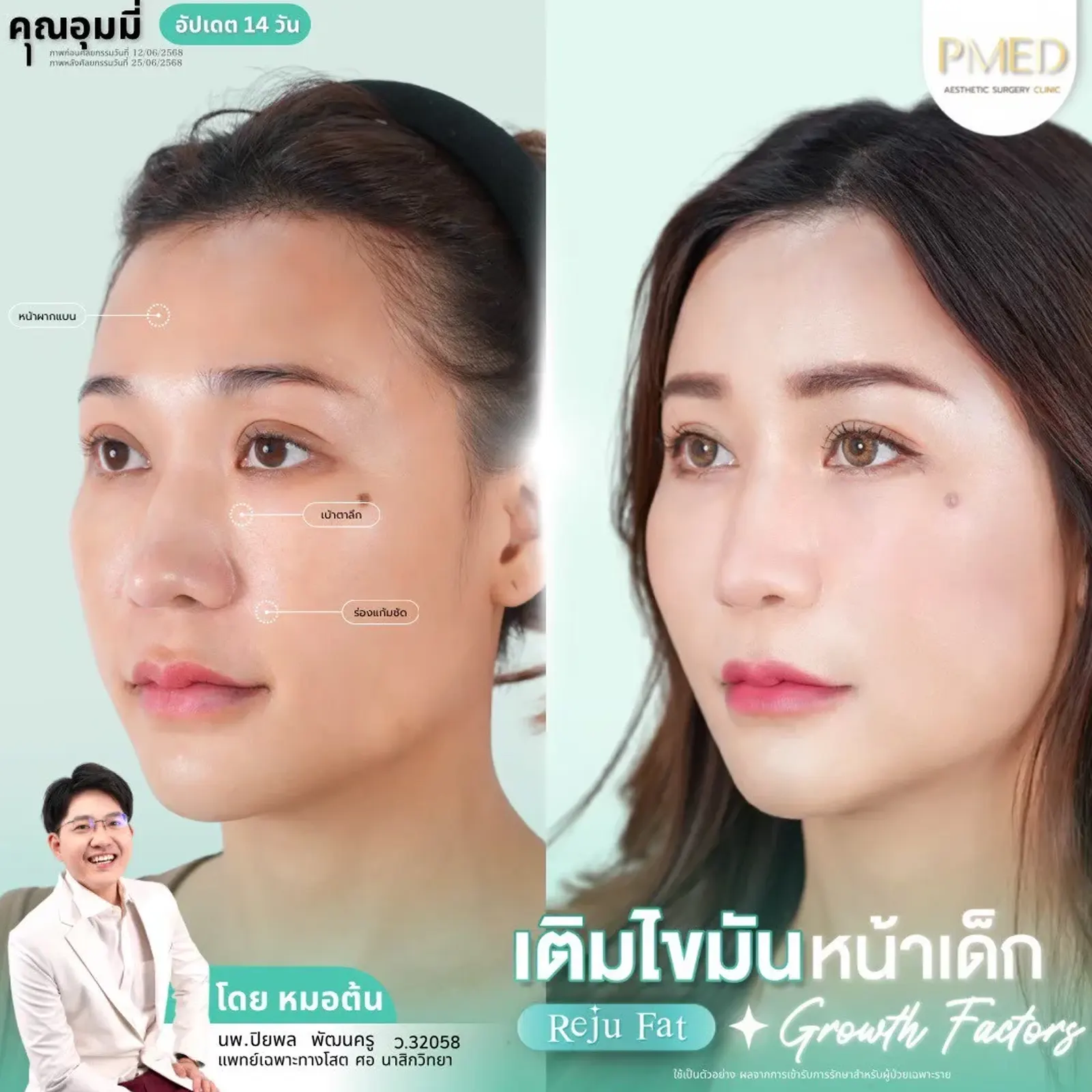 facial-fat-grafting-00015