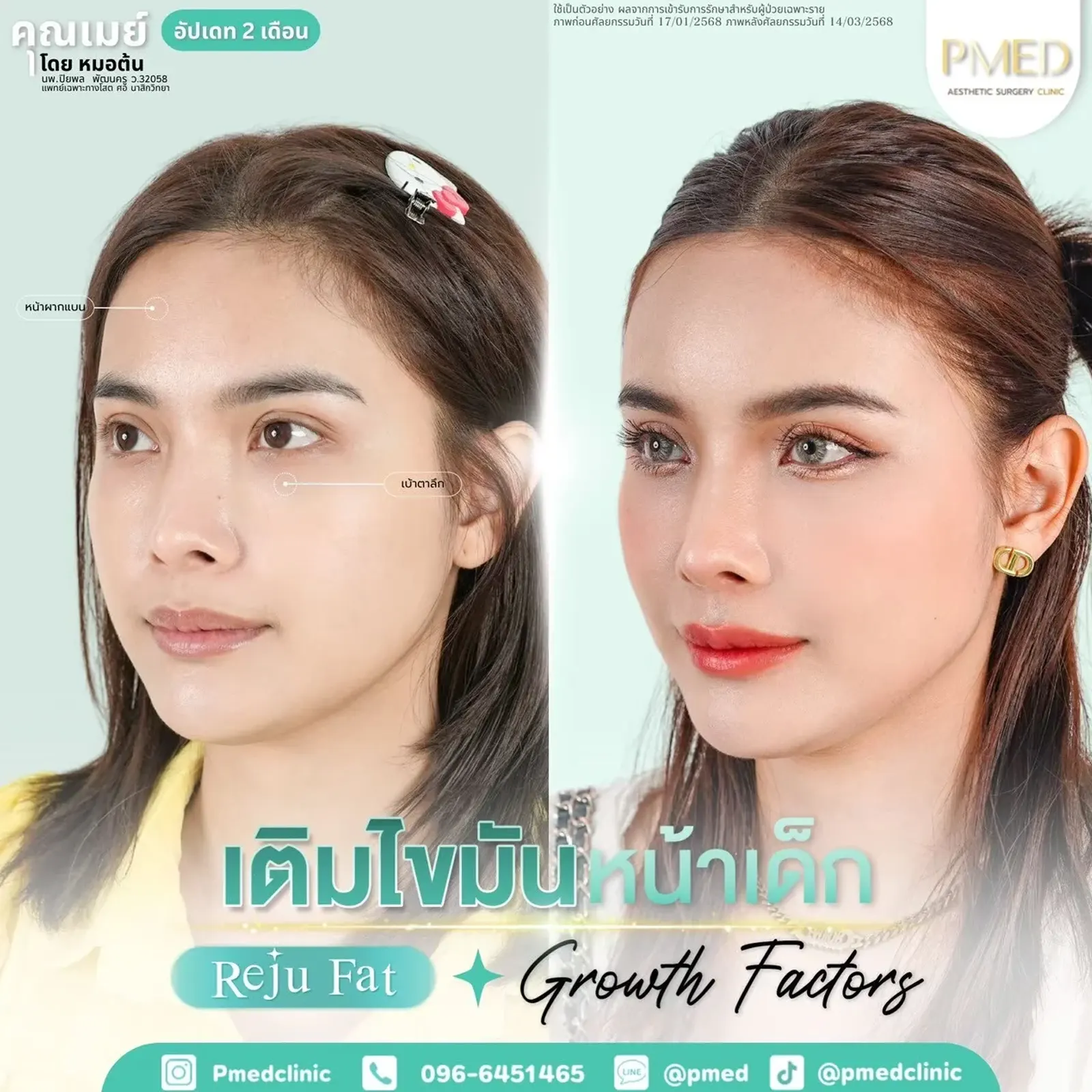 facial-fat-grafting-00016