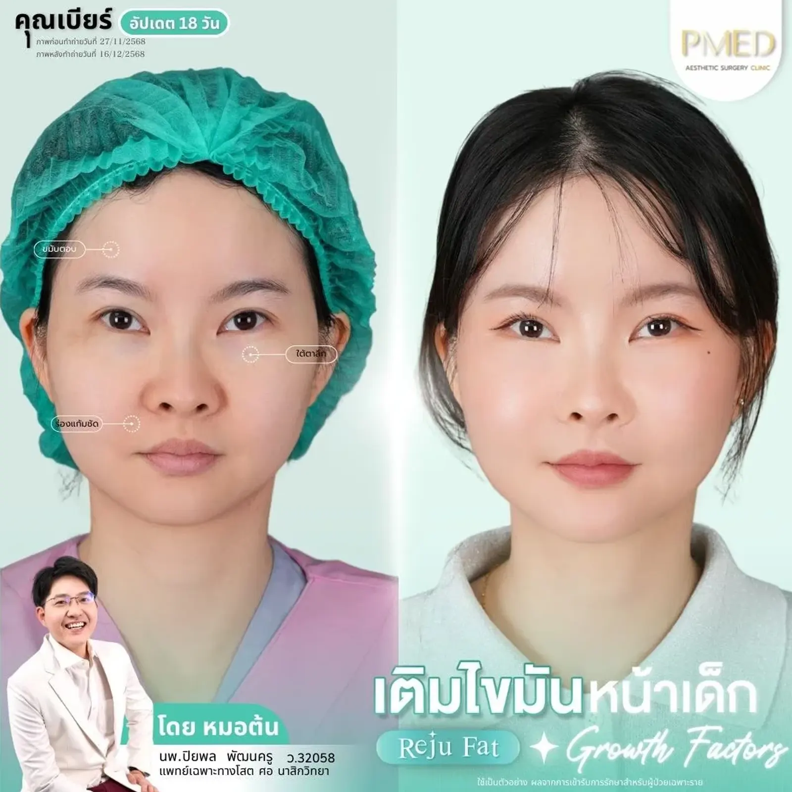 facial-fat-grafting-00017