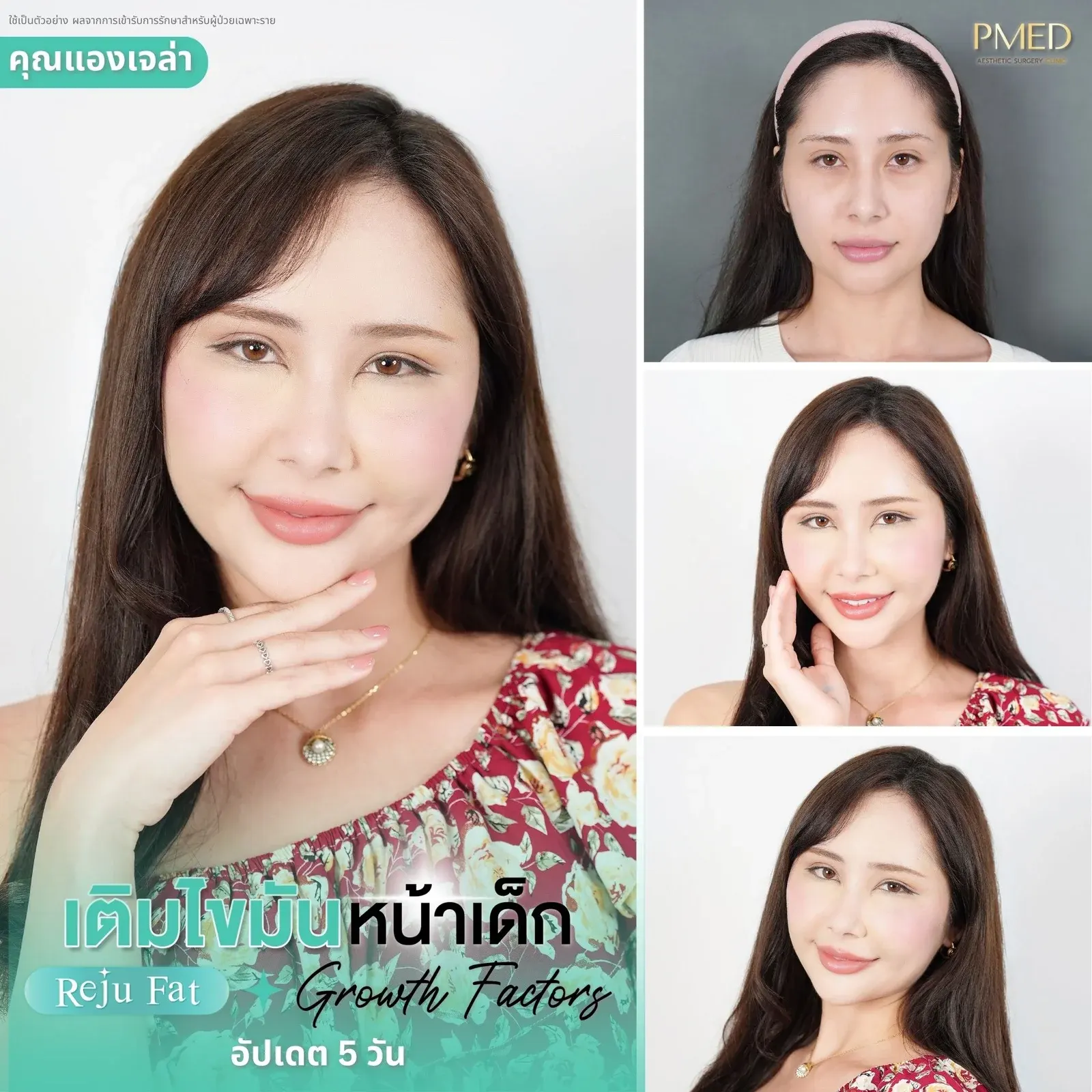 facial-fat-grafting-00018