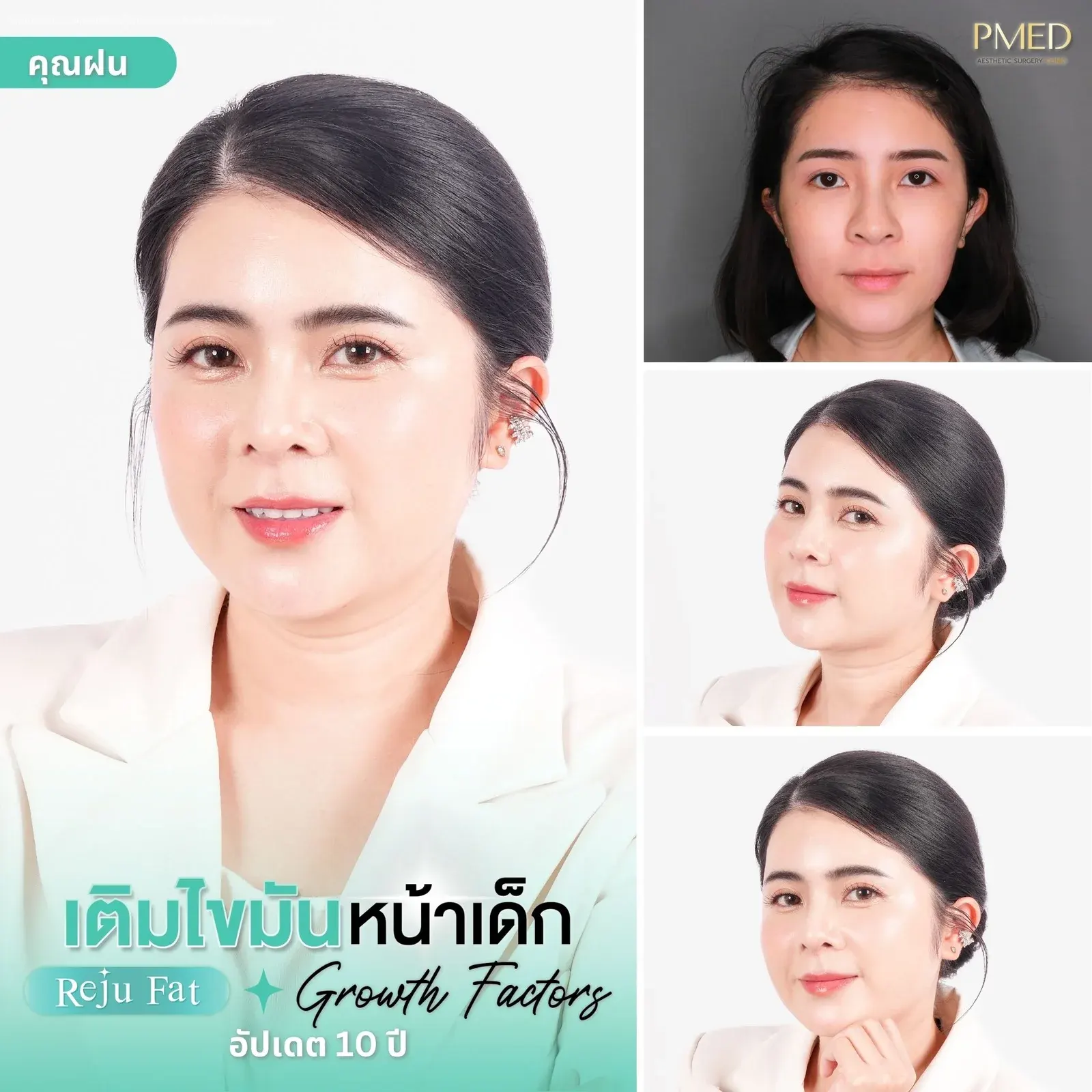 facial-fat-grafting-00019