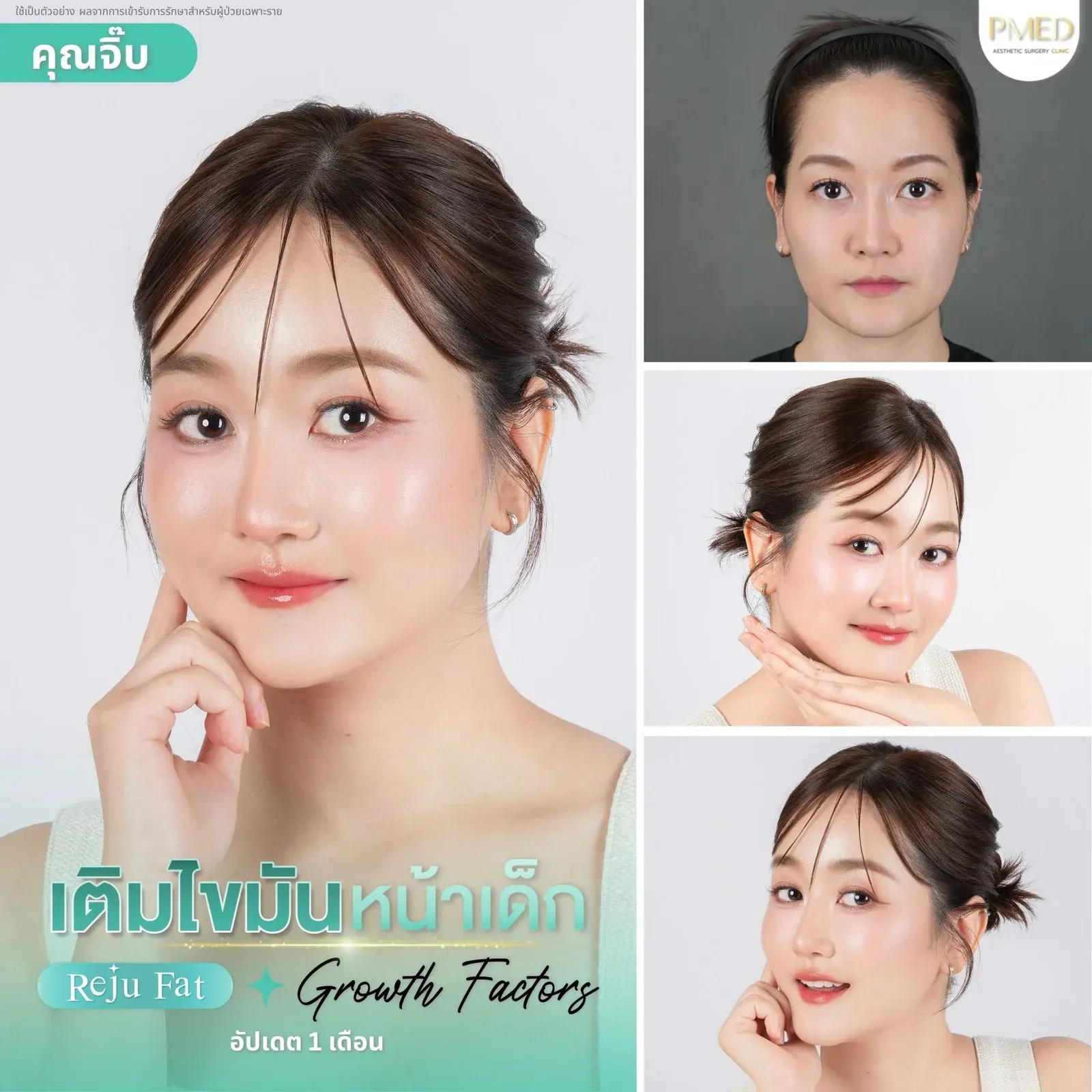 facial-fat-grafting-00020