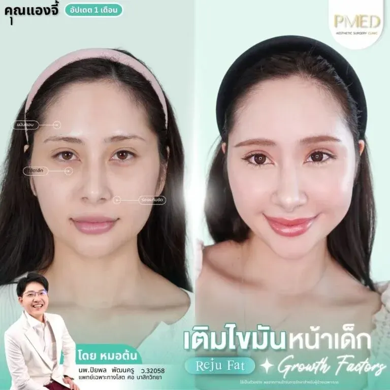 facial-fat-grafting-00023