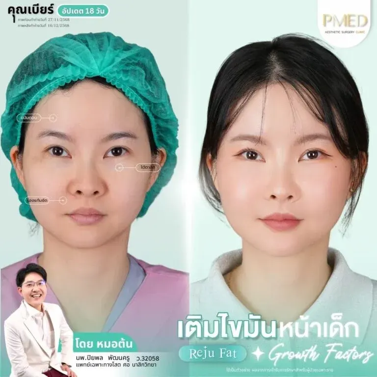 facial-fat-grafting-00024