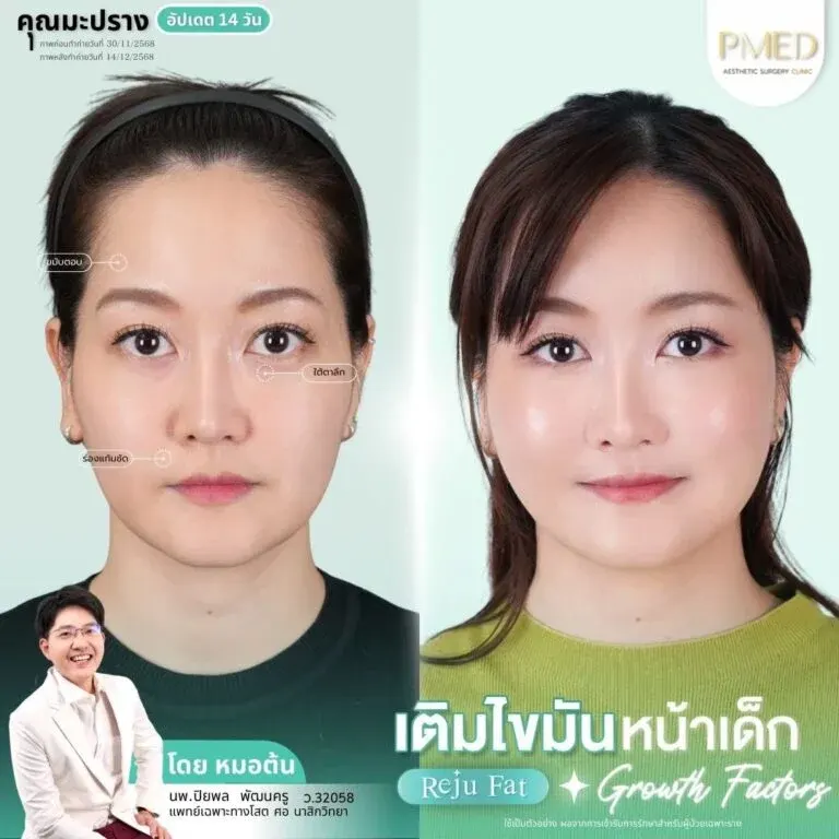 facial-fat-grafting-00025