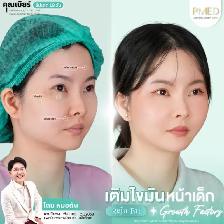 facial-fat-grafting-00026