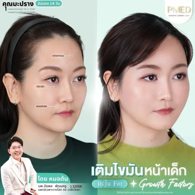 facial-fat-grafting-00027