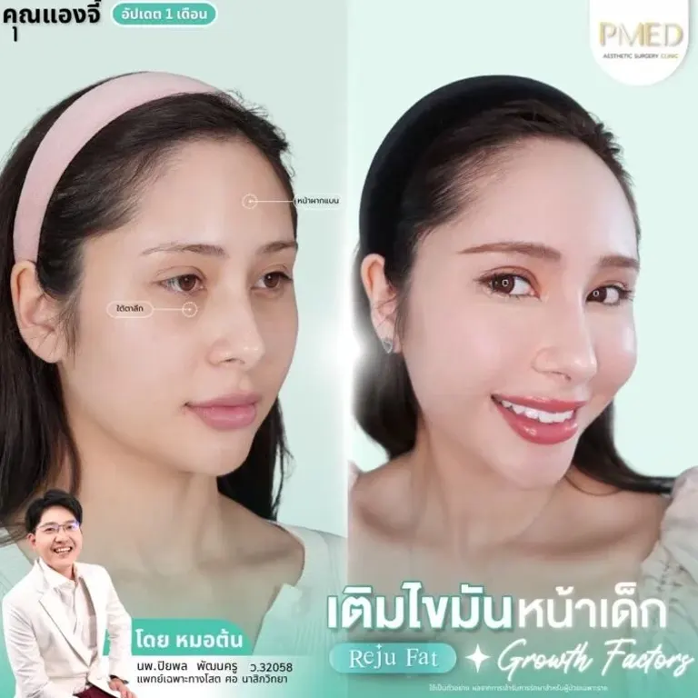 facial-fat-grafting-00028
