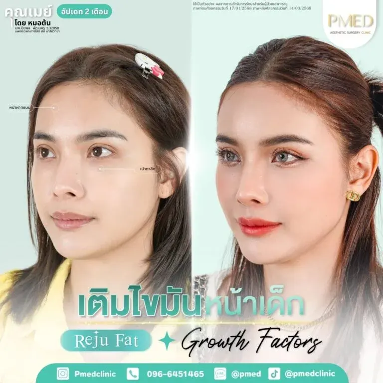 facial-fat-grafting-00029