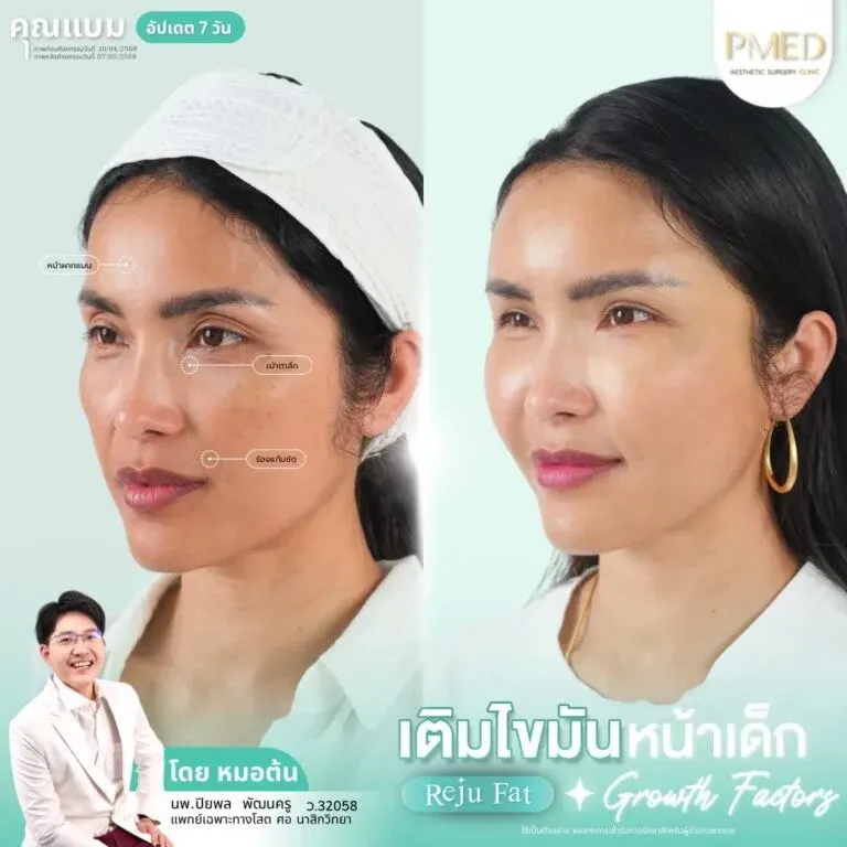 facial-fat-grafting-00030