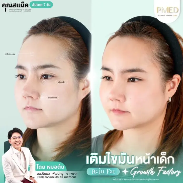 facial-fat-grafting-00031