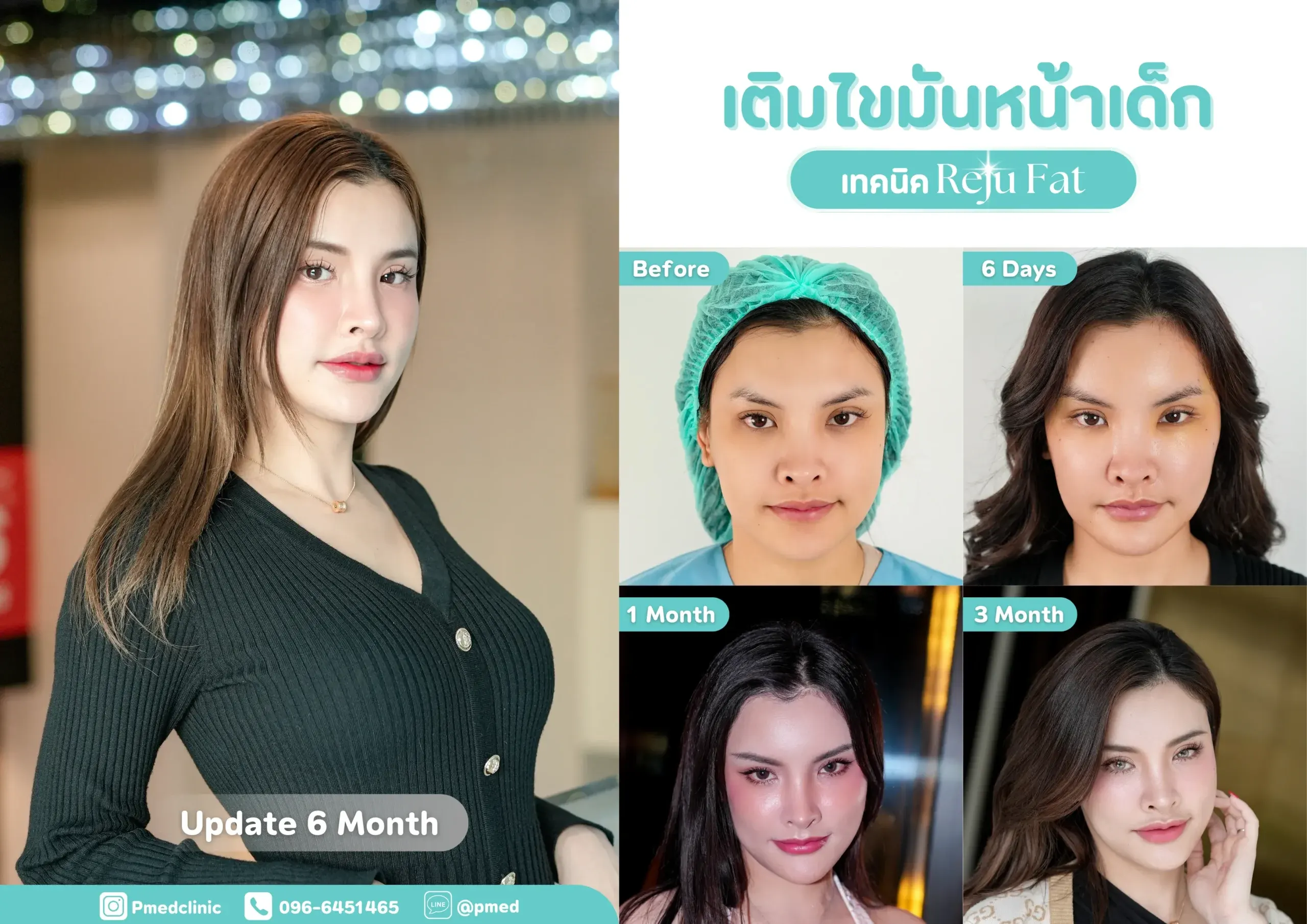 facial-fat-grafting-00036