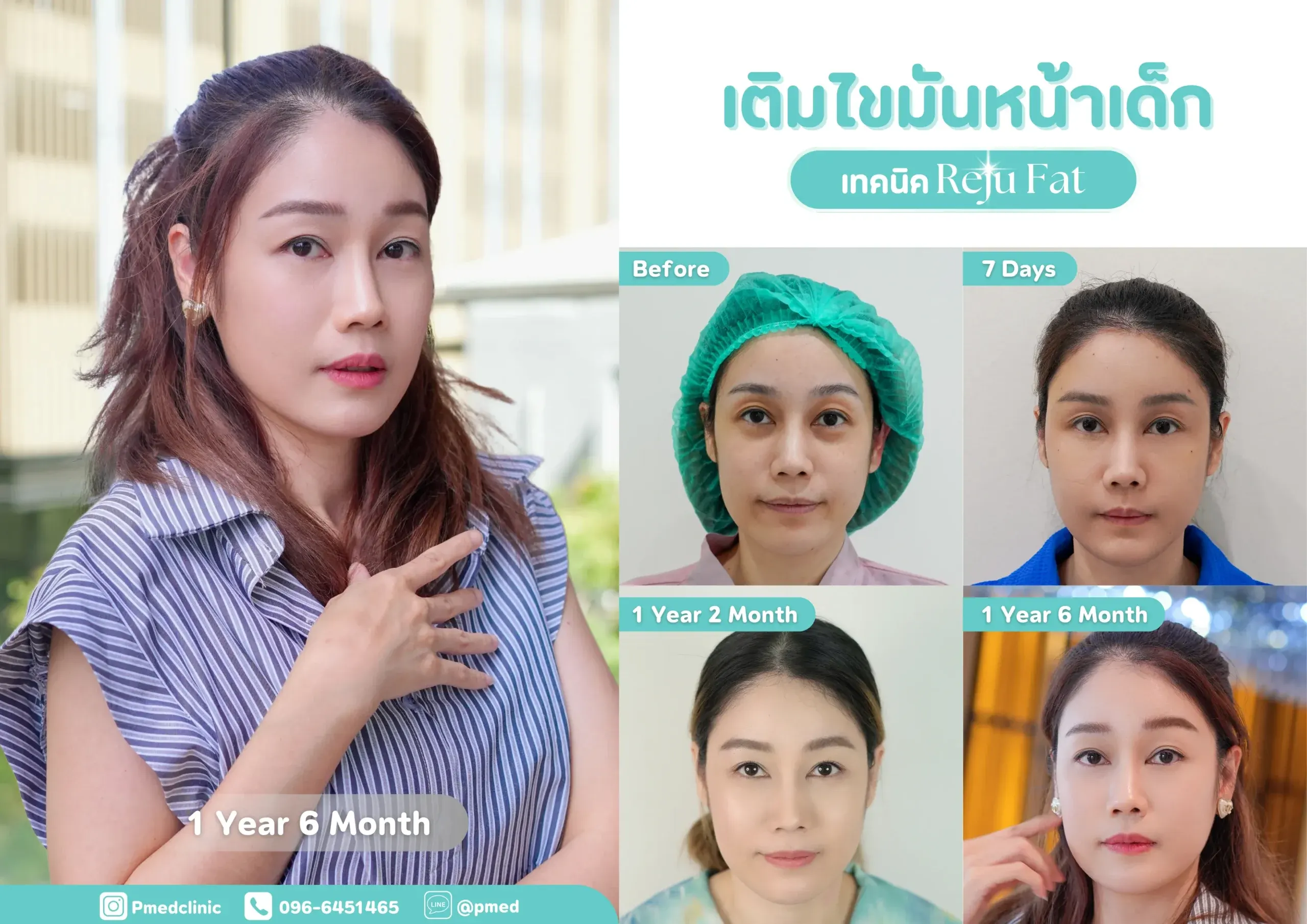 facial-fat-grafting-00037