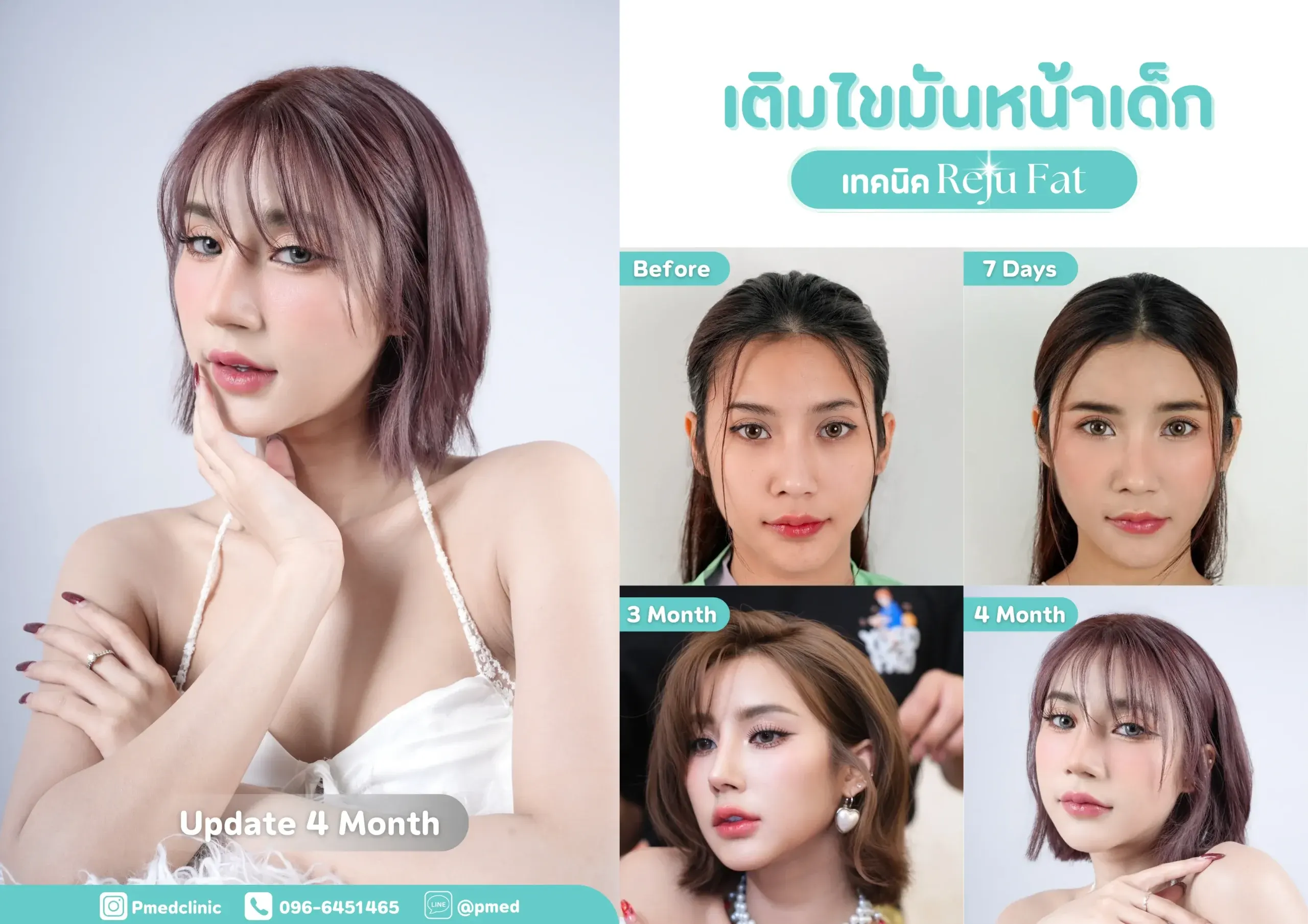 facial-fat-grafting-00038
