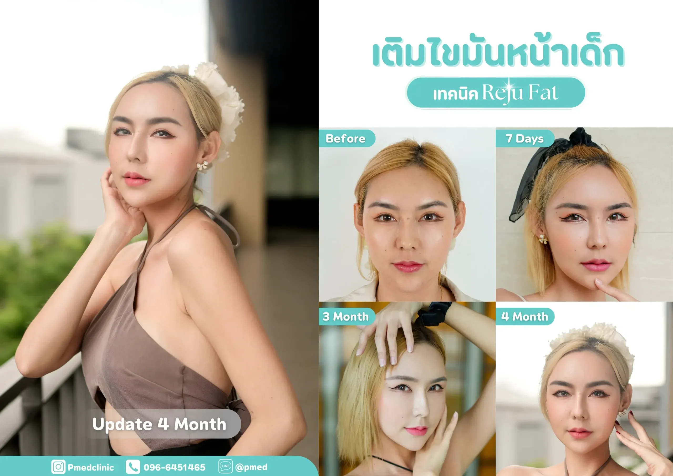 facial-fat-grafting-00039