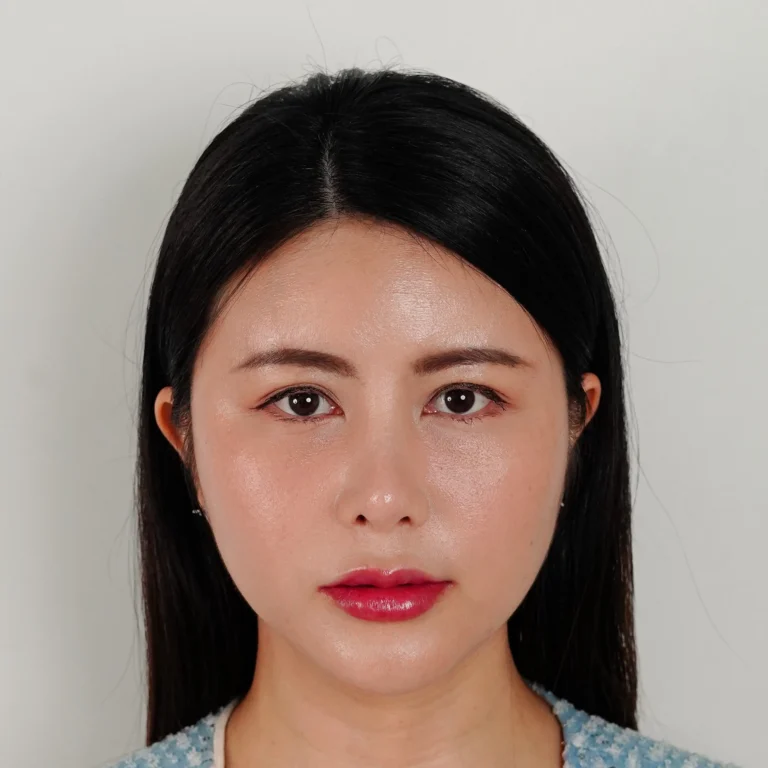 facial-fat-grafting-00045