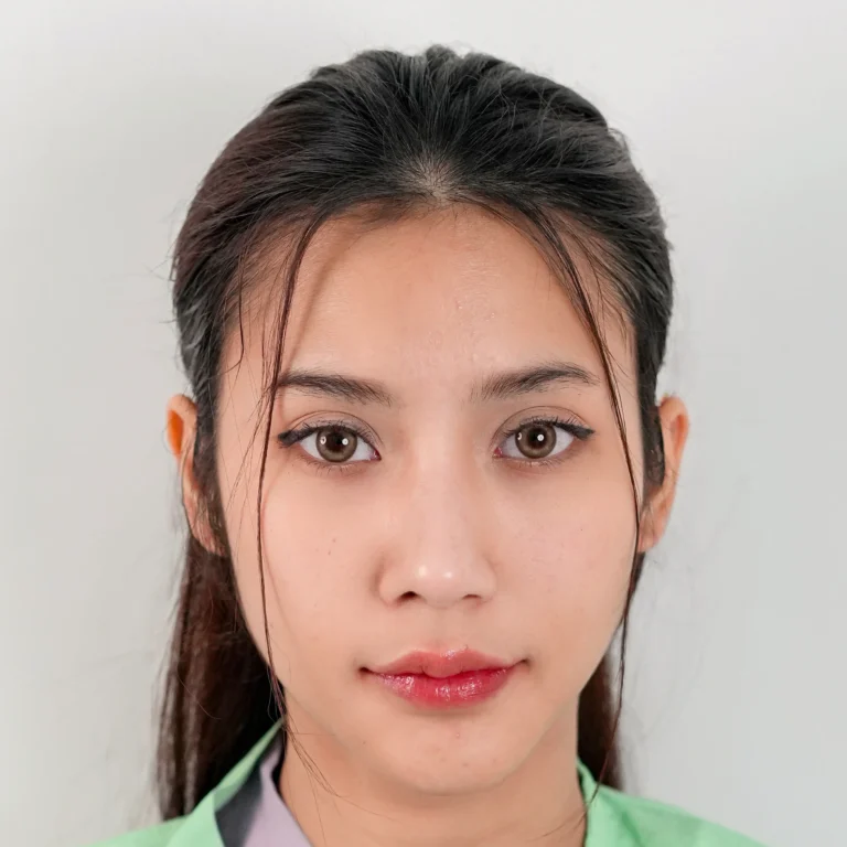 facial-fat-grafting-00048