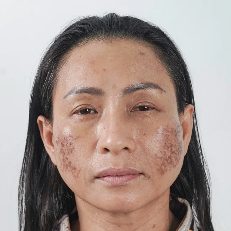 facial-fat-grafting-00050