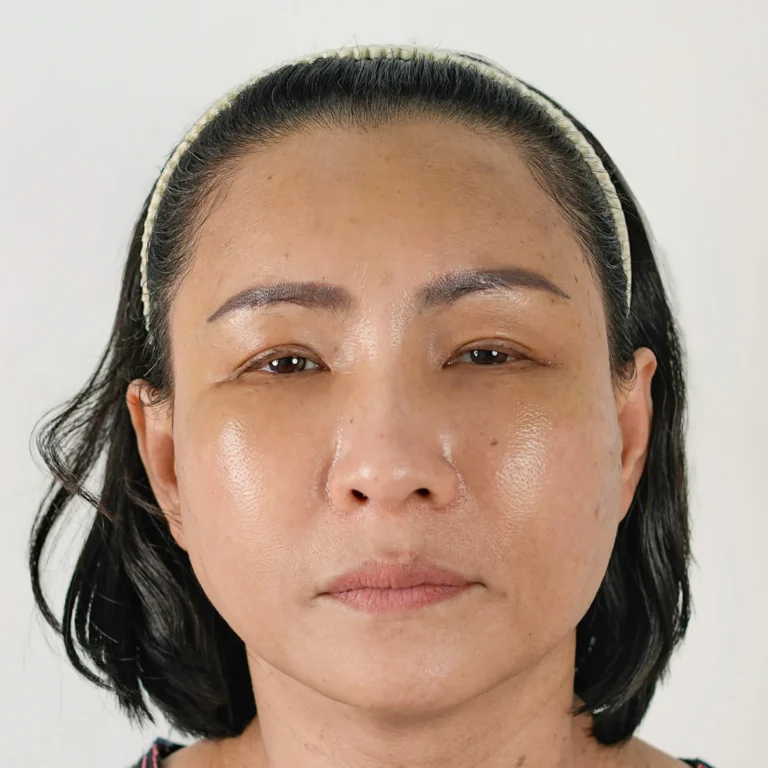 facial-fat-grafting-00051