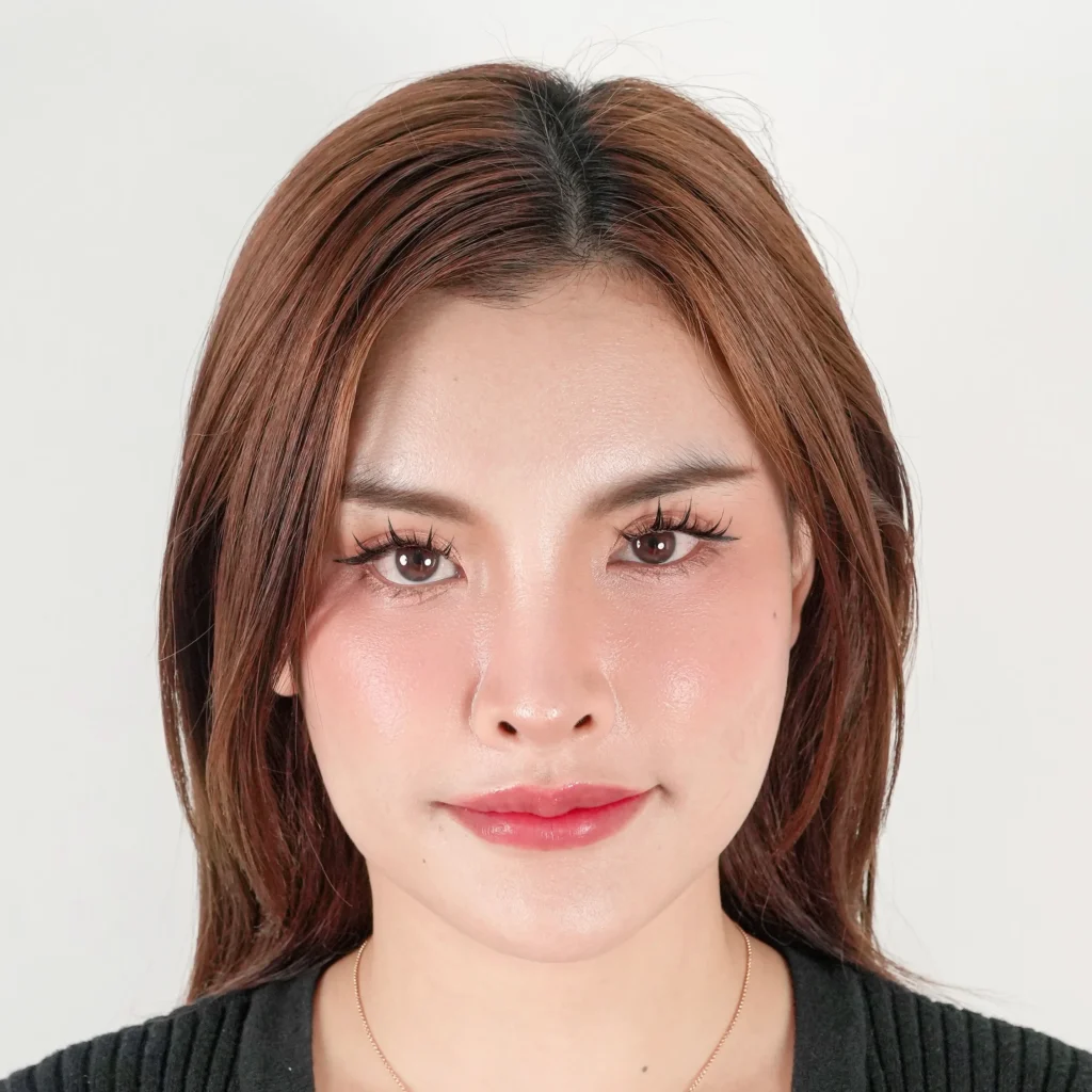 facial-fat-grafting-00052