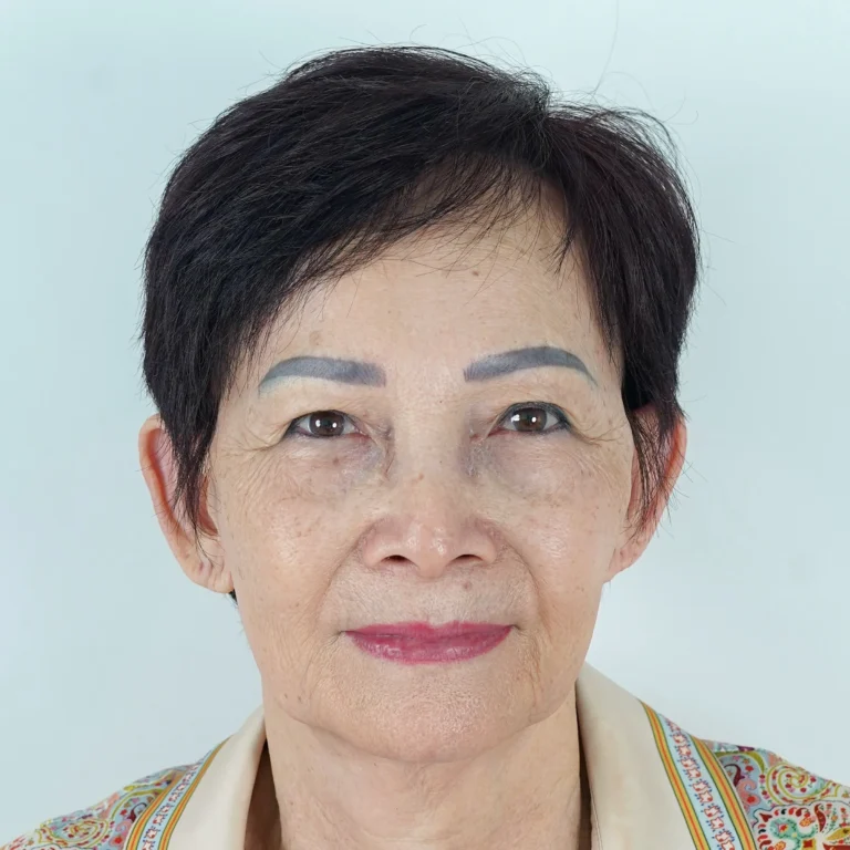 facial-fat-grafting-00054