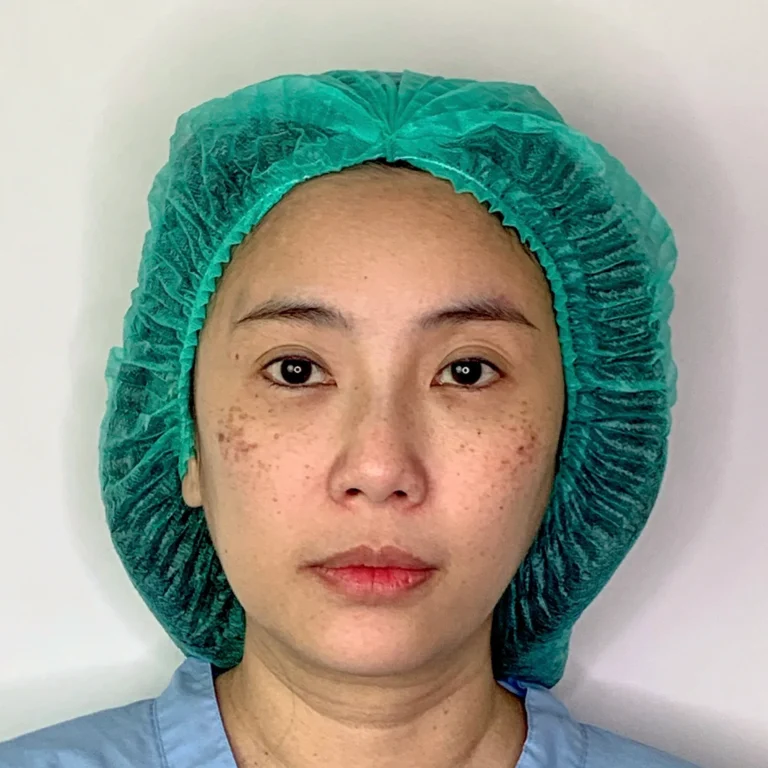 facial-fat-grafting-00057