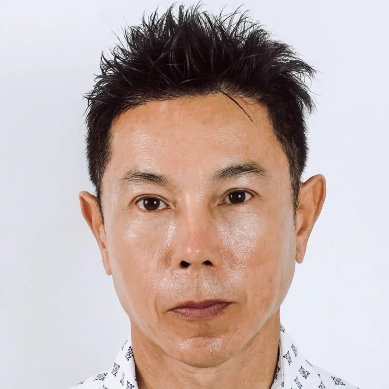 facial-fat-grafting-00059