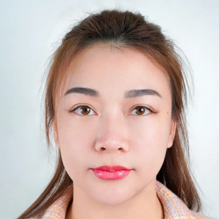 facial-fat-grafting-00064